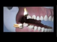 /album/cirugia-de-cordales/cordal-4-jpg/